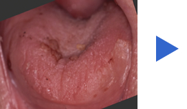 乾燥した舌と保湿した舌　口腔内の状態