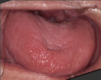 乾燥した舌と保湿した舌　口腔内の状態