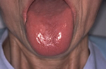 舌痛症患者